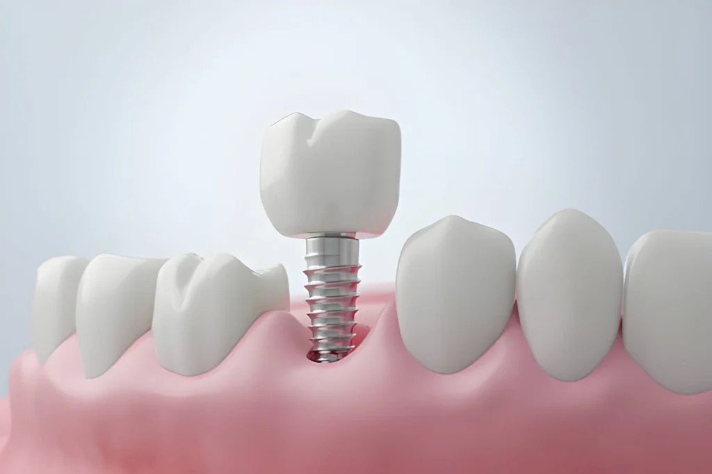 Titanium dental implant used for molar tooth replacement.