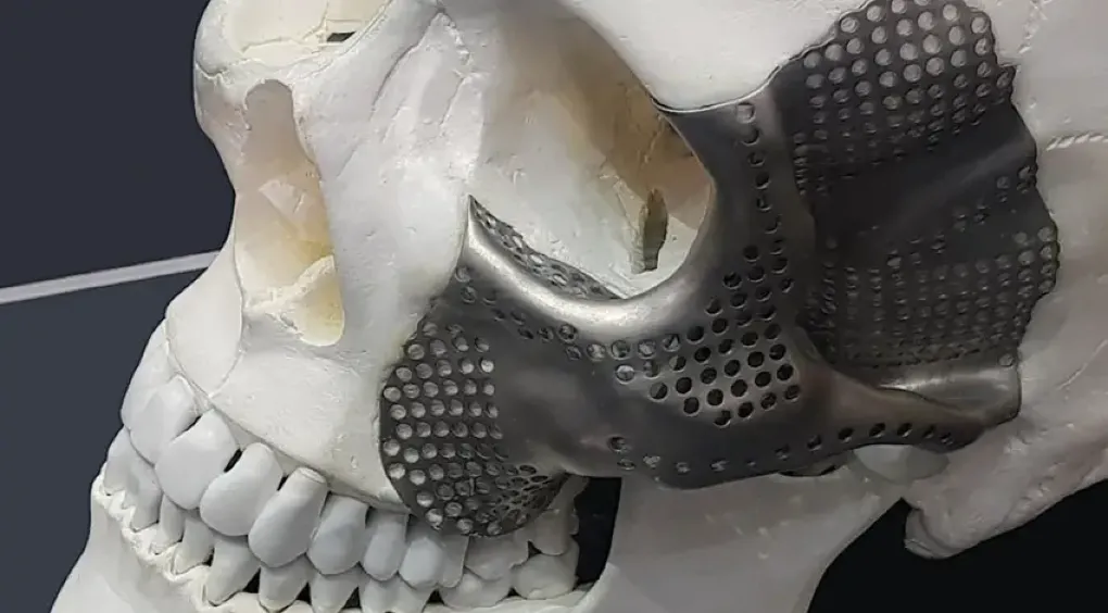 3D-printed titanium mesh implant fitted onto a skull model's facial bone structure.